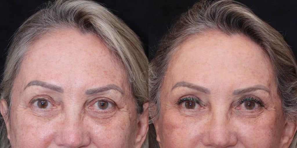 Resultado Forehead Lift antes e depois