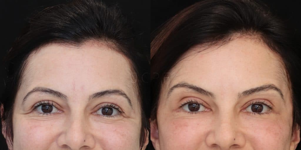 JCPF_Forehead Lift 04_GS2