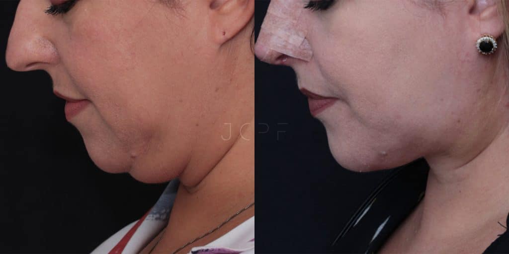 JCPF_Neck Lift_resultado06_GS2