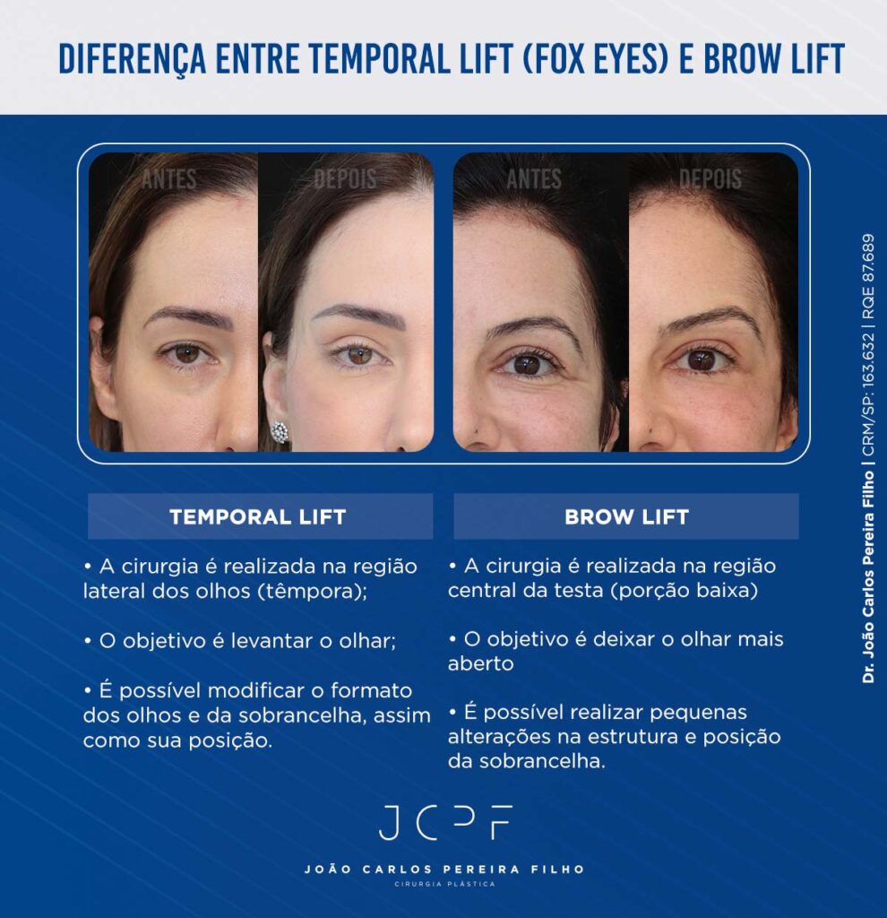 Diferença entre Temporal Lift (Fox Eyes) e Brow Lift

Temporal Lift
A cirurgia é realizada na região lateral dos olhos (têmpora)
O objetivo é levantar o olhar
É possível modificar o formato dos olhos e da sobrancelha, assim como sua posição

Brow Lift
A cirurgia é realizada na região central da testa (porção baixa)
O objetivo é deixar o olhar mais aberto
É possível realizar pequenas alterações na estrutura e posição da sobrancelha