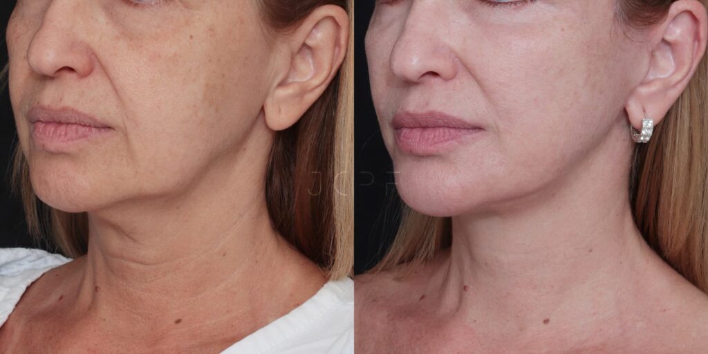Comparação antes e depois de rejuvenescimento facial mostrando melhora na firmeza da pele e contorno do rosto.