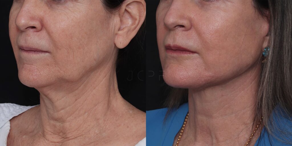Antes e depois de Deep Plane Face Lift mostrando melhora da flacidez facial e do contorno da mandíbula