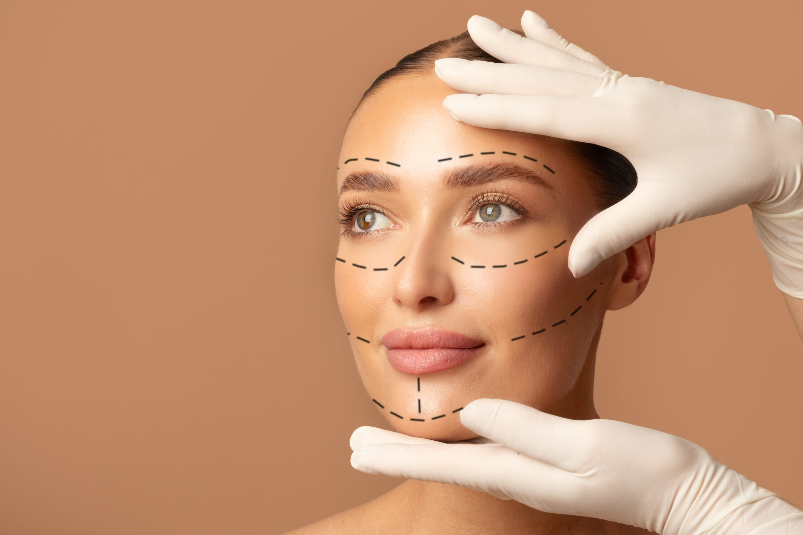 Mulher com marcações cirúrgicas no rosto indicando áreas tratadas pelo deep plane facelift, com mãos de cirurgião posicionando a face para demonstrar reposicionamento estrutural.
