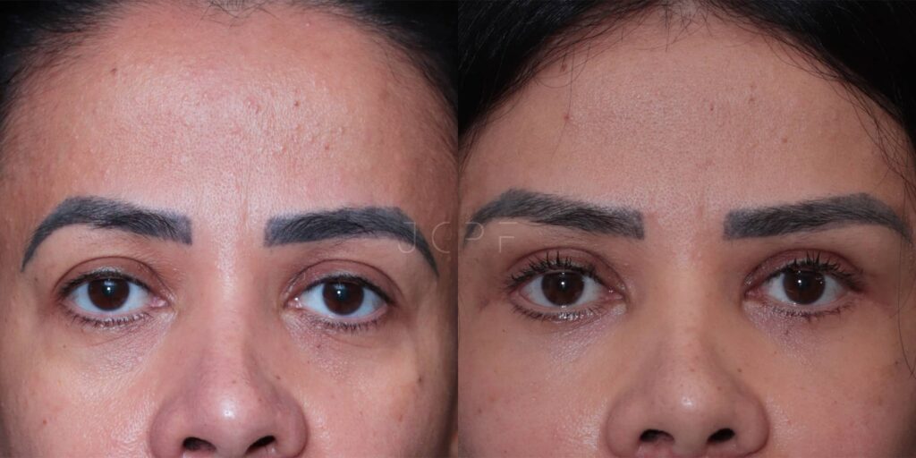 Antes e depois de mulher que realizou a cirurgia de blefaroplastia.