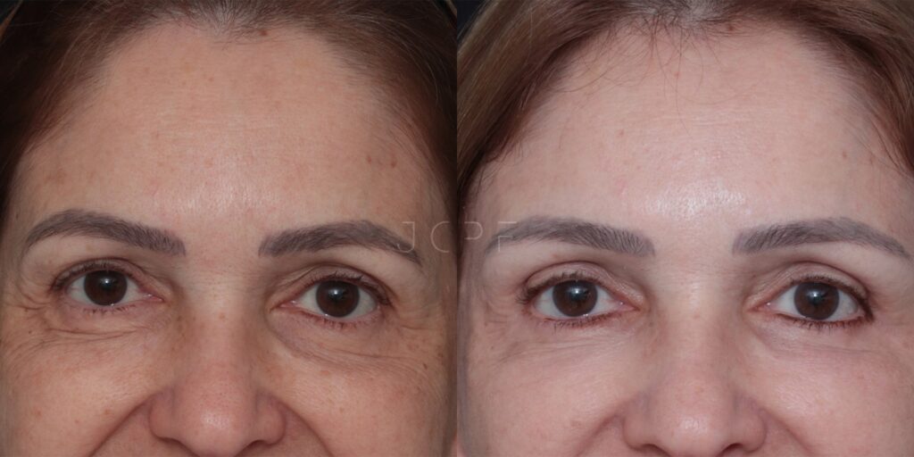 Antes e depois de mulher que realizou a cirurgia de blefaroplastia.