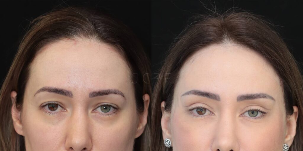 Antes e depois de mulher que realizou a cirurgia de blefaroplastia.