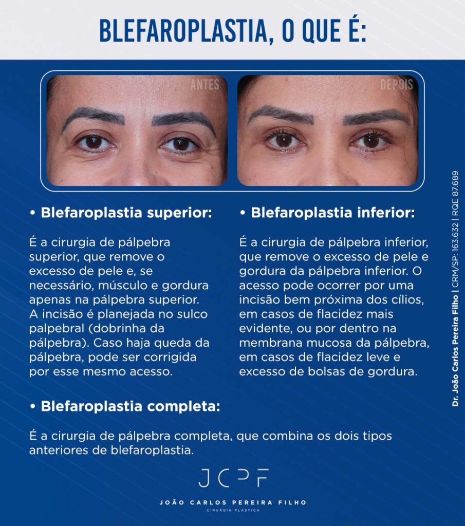 Blefaroplastia, o que é:
• Blefaroplastia superior:
É a cirurgia de pálpebra superior, que remove o excesso de pele e, se necessário, músculo e gordura apenas na pálpebra superior. A incisão é planejada no sulco palpebral (dobrinha da pálpebra). Caso haja queda da pálpebra, pode ser corrigida por esse mesmo acesso. 

• Blefaroplastia inferior:
É a cirurgia de pálpebra inferior, que remove o excesso de pele e gordura da pálpebra inferior. O acesso pode ocorrer por uma incisão bem próxima dos cílios, em casos de flacidez mais evidente, ou por dentro na membrana mucosa da pálpebra, em casos de flacidez leve e excesso de bolsas de gordura.

• Blefaroplastia completa:
É a cirurgia de pálpebra completa, que combina os dois tipos anteriores de blefaroplastia.