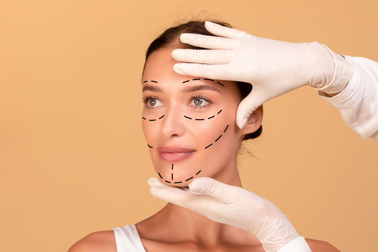 Mulher jovem com marcações no rosto para realizar Lifting Facial.
