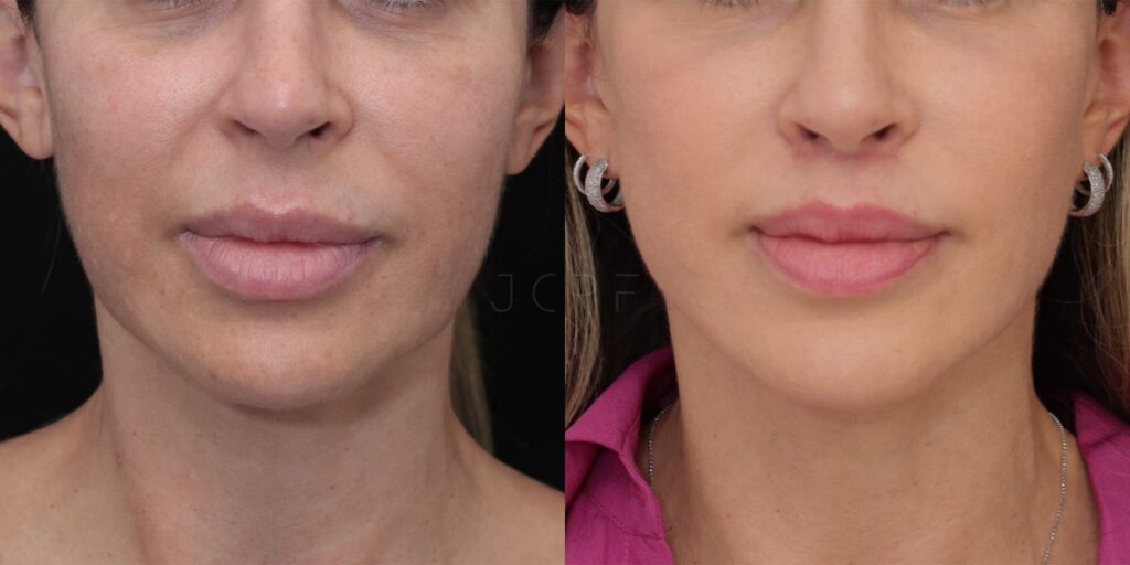 Comparação de fotos de antes e depois de cirurgia Lip Lift em paciente.