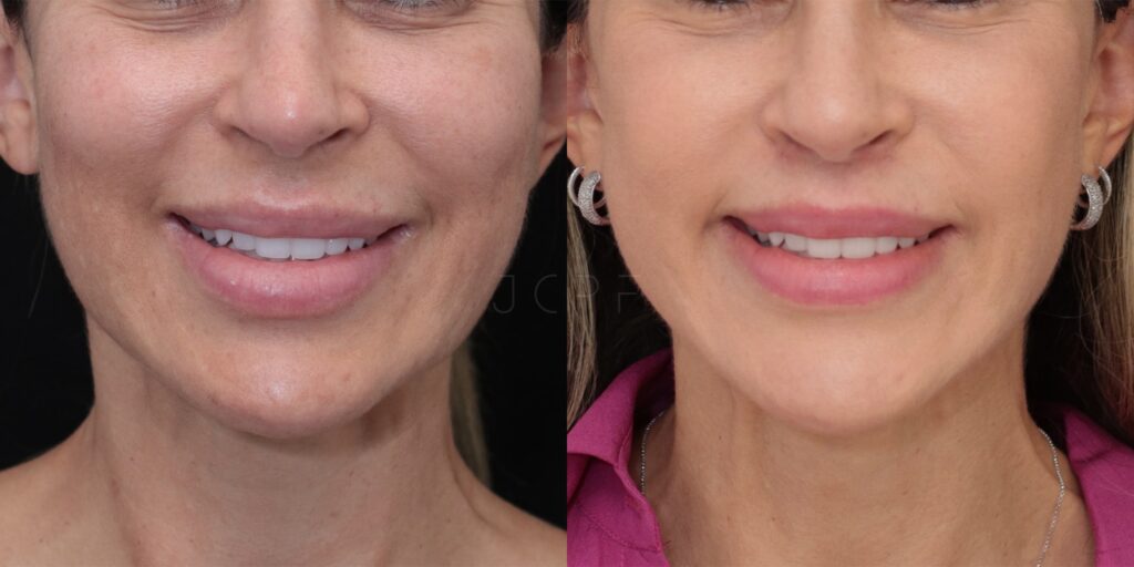 Foto mostrando resultado da cirurgia Lip Lift em paciente.