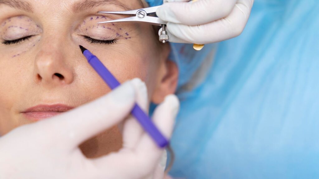 Rosto de mulher sendo marcado para cirurgia de blefaroplastia.