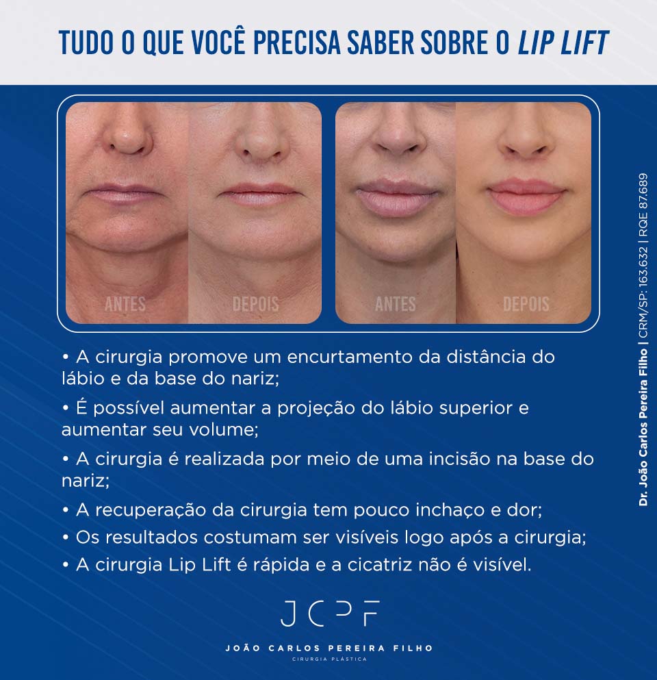 Tudo o que você precisa saber sobre o Lip Lif
A cirurgia promove um encurtamento da distância do lábio e da base do nariz;
É possível aumentar a projeção do lábio superior e aumentar seu volume;
A cirurgia é realizada por meio de uma incisão na base do nariz;
A recuperação da cirurgia tem pouco inchaço e dor;
Os resultados costumam ser visíveis logo após a cirurgia;
A cirurgia Lip Lift é rápida e a cicatriz não é visível.
