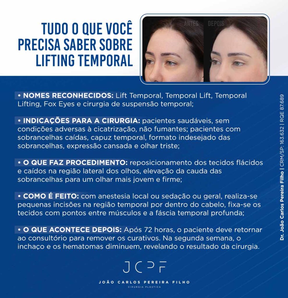 Tudo o que você precisa saber sobre Lifting Temporal
Nomes reconhecidos: Lift Temporal, Temporal Lift, Temporal Lifting, Fox Eyes e cirurgia de suspensão temporal.
Indicações para a cirurgia: pacientes saudáveis, sem condições adversas à cicatrização, não fumantes; pacientes com sobrancelhas caídas, capuz temporal, formato indesejado das sobrancelhas, expressão cansada e olhar triste.
O que faz o procedimento: reposicionamento dos tecidos flácidos e caídos na região lateral dos olhos, elevação da cauda das sobrancelhas para um olhar mais jovem e firme.
Como é feito: com anestesia local ou sedação ou geral, realiza-se pequenas incisões na região temporal por dentro do cabelo, fixa-se os tecidos com pontos entre músculos e a fáscia temporal profunda.
O que acontece depois: Após 72 horas, o paciente deve retornar ao consultório para remover os curativos. Na segunda semana, o inchaço e os hematomas diminuem, revelando o resultado da cirurgia.
