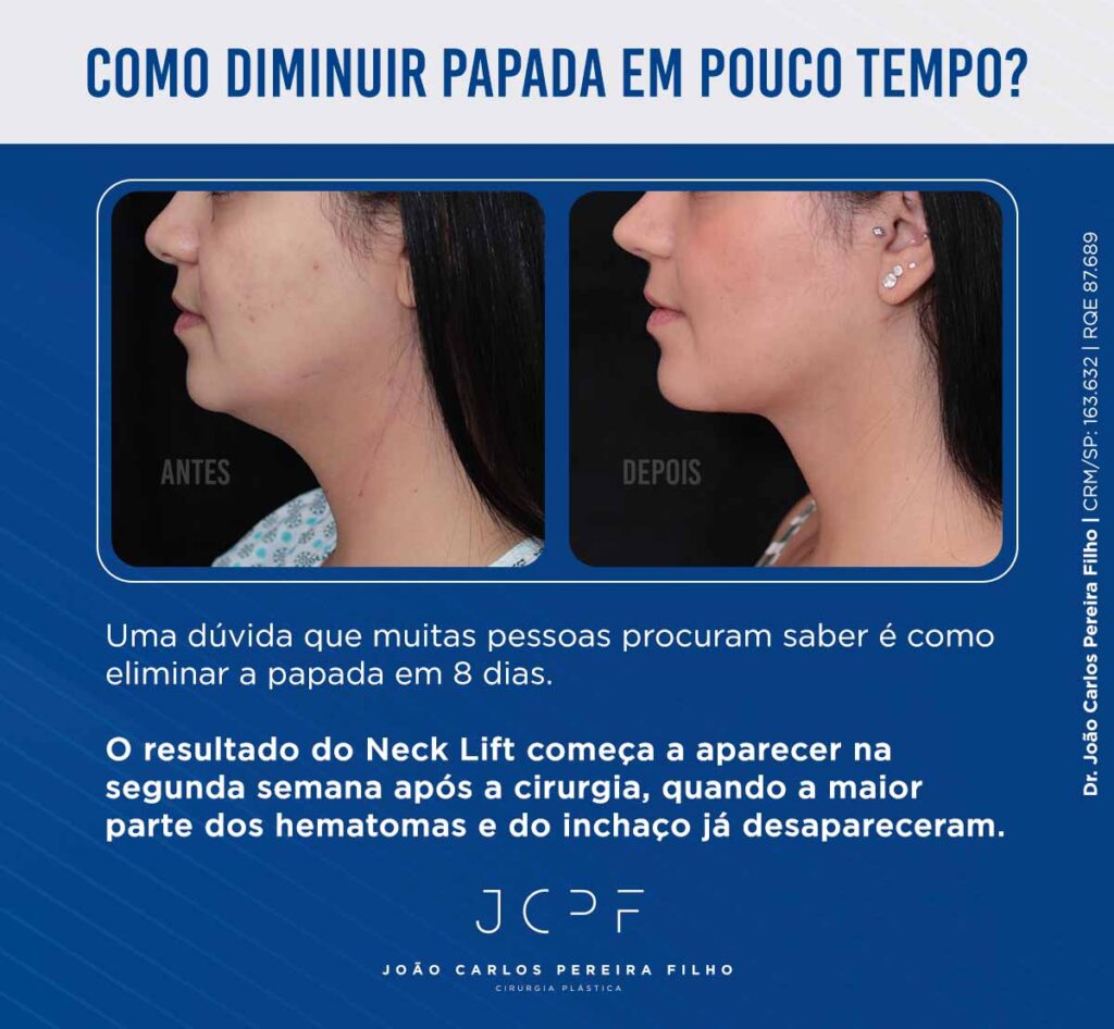 Como diminuir papada em pouco tempo? Uma dúvida que muitas pessoas procuram saber é como eliminar a papada em 8 dias. O resultado do Neck Lift começa a aparecer na segunda semana após a cirurgia, quando a maior parte dos hematomas e do inchaço já desapareceram.