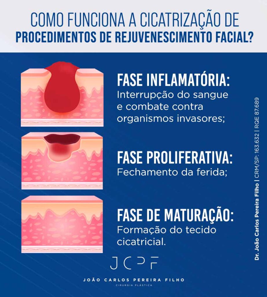 Como funciona a cicatrização de procedimentos de rejuvenescimento facial? Fase inflamatória: Interrupção do sangue e combate contra organismos invasores. Fase proliferativa: Fechamento da ferida. Fase de maturação: Formação do tecido cicatricial.