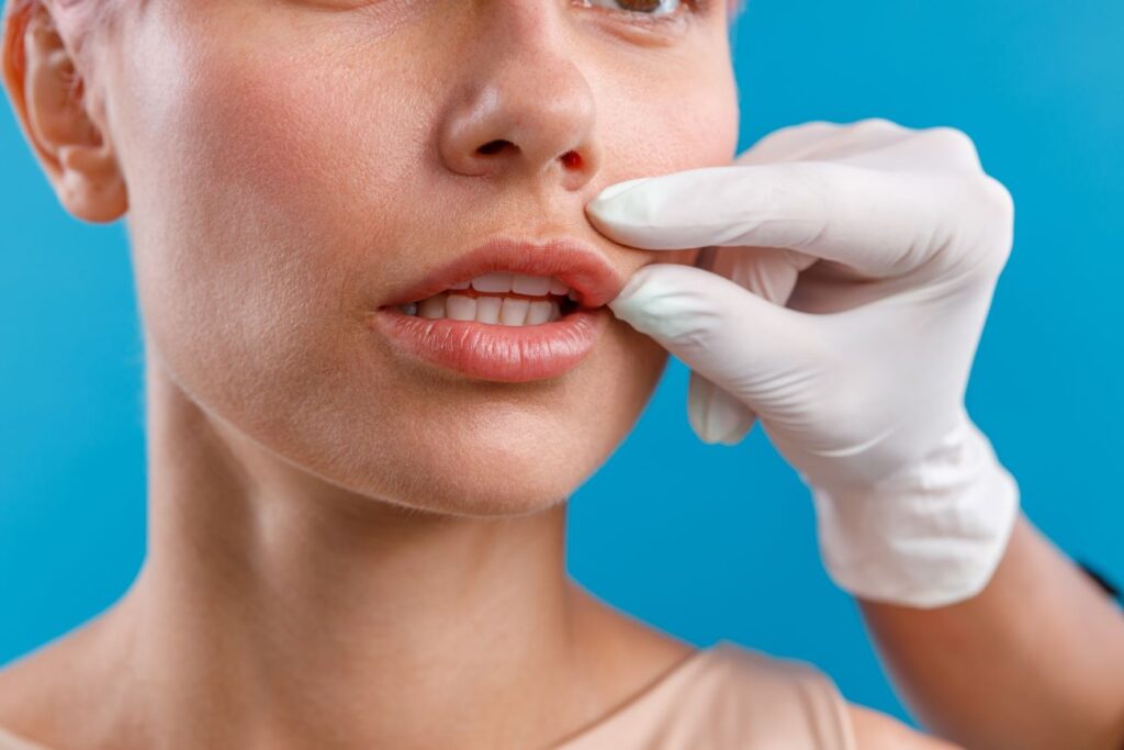 Profissional simulando diferença de lip lift antes e depois.