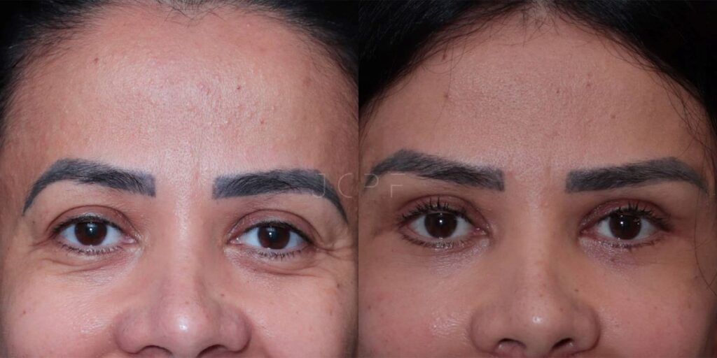 Foto de resultado de blefaroplastia antes e depois de mulher.