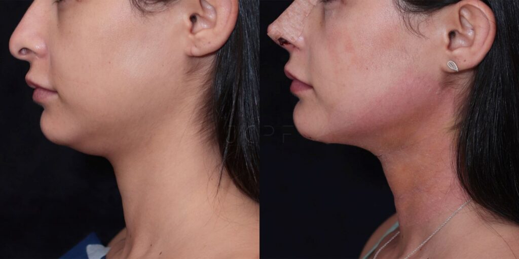 Antes e depois de resultado de Neck Lift para remover papada.