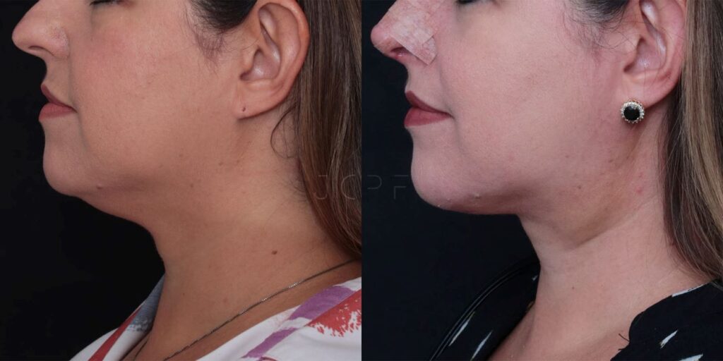 Antes e depois de resultado de Neck Lift para remover papada.