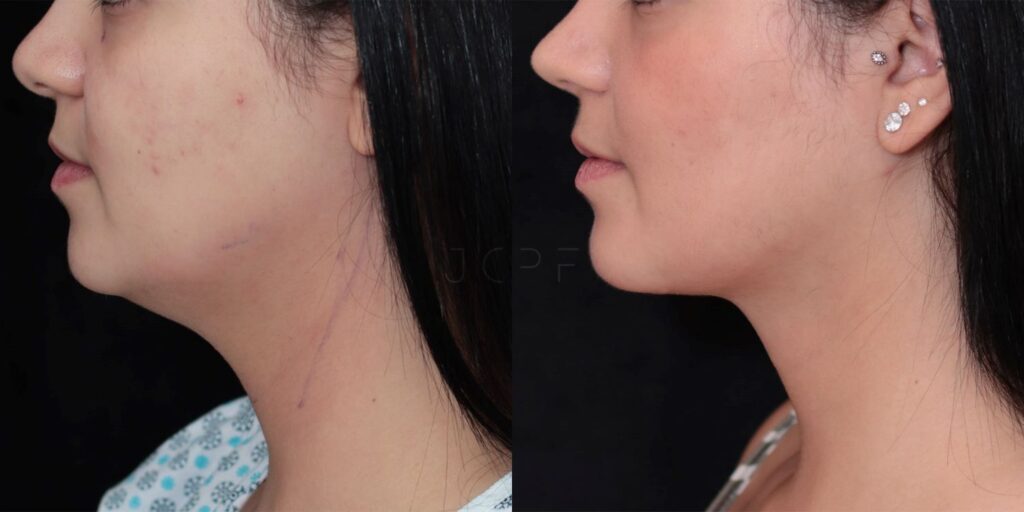 Antes e depois de resultado de Neck Lift para remover papada.