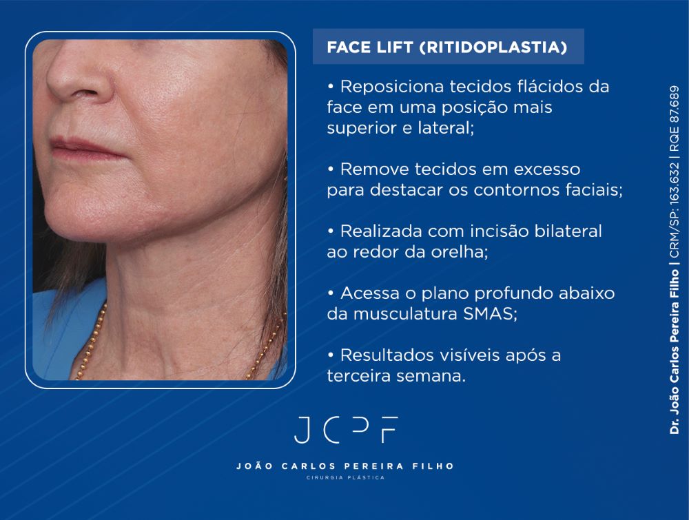 Face Lift (Ritidoplastia) Reposiciona tecidos flácidos da face em uma posição mais superior e lateral; Remove tecidos em excesso para destacar os contornos faciais; Realizada com incisão bilateral ao redor da orelha; Acessa o plano profundo abaixo da musculatura SMAS;; Resultados visíveis após a terceira semana.