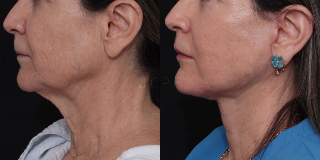 Foto de perfil de resultado de Face Lift antes e depois