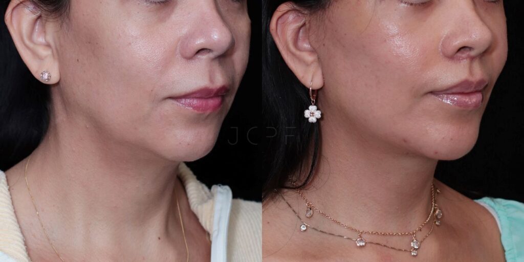 Resultado de face lift antes e depois de paciente.