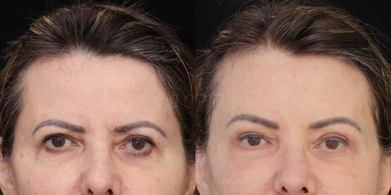 Antes e depois de Brow Lift realizado pelo Dr. João Carlos Pereira Filho — paciente jovem com sobrancelhas reposicionadas e olhar mais aberto e descansado.
