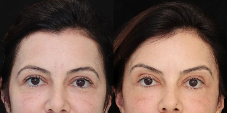 Resultado de Brow Lift antes e depois pelo Dr. João Carlos Pereira Filho — paciente com rejuvenescimento visível do terço superior da face e sobrancelhas elevadas.
