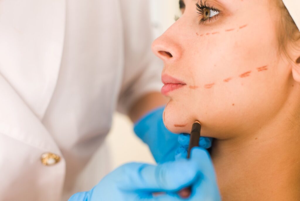 mulher com marcas feitas no rosto, sugerindo um planejamento para um procedimento estético. Ela está sendo atendida por um profissional, que utiliza luvas azuis e segura um instrumento de marcação.