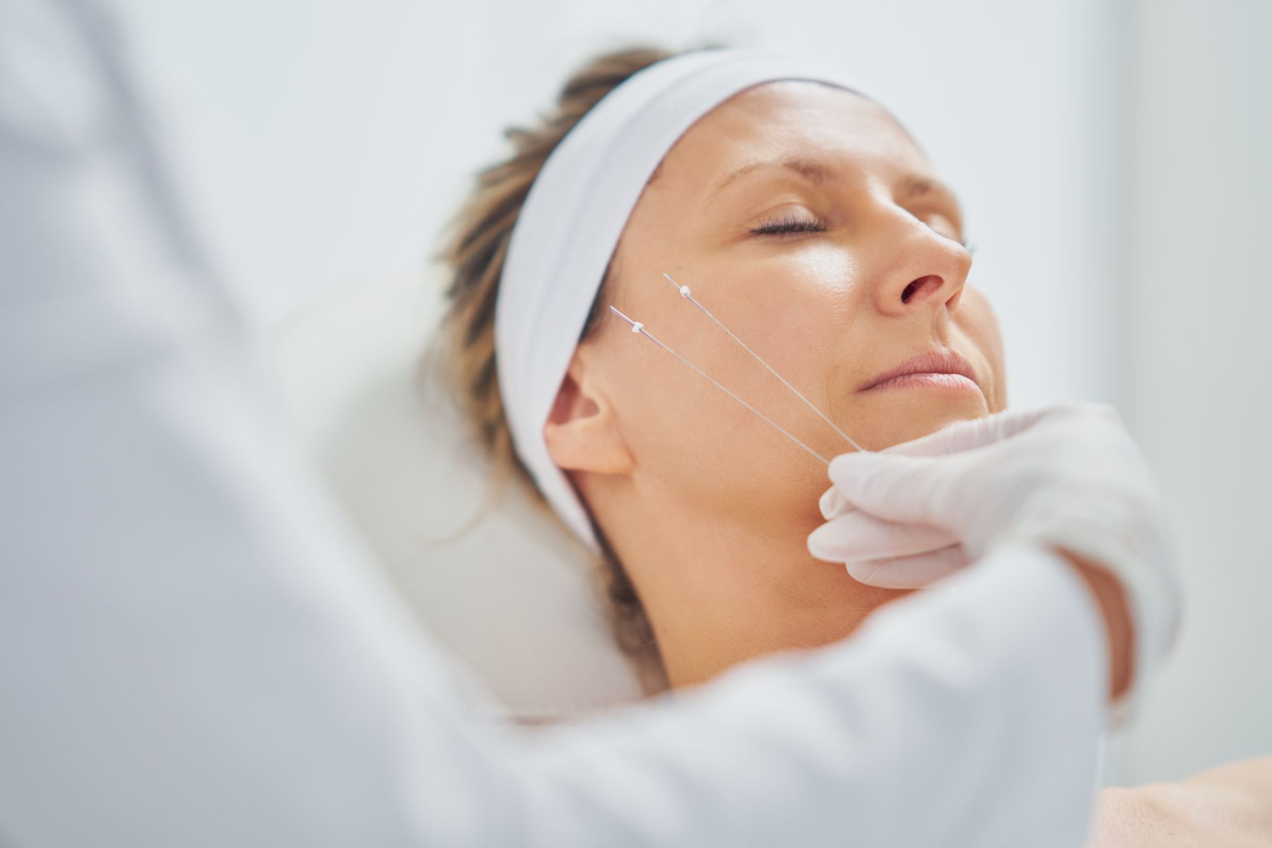 Mulher realizando procedimento de harmonização facial Fios de PDO.