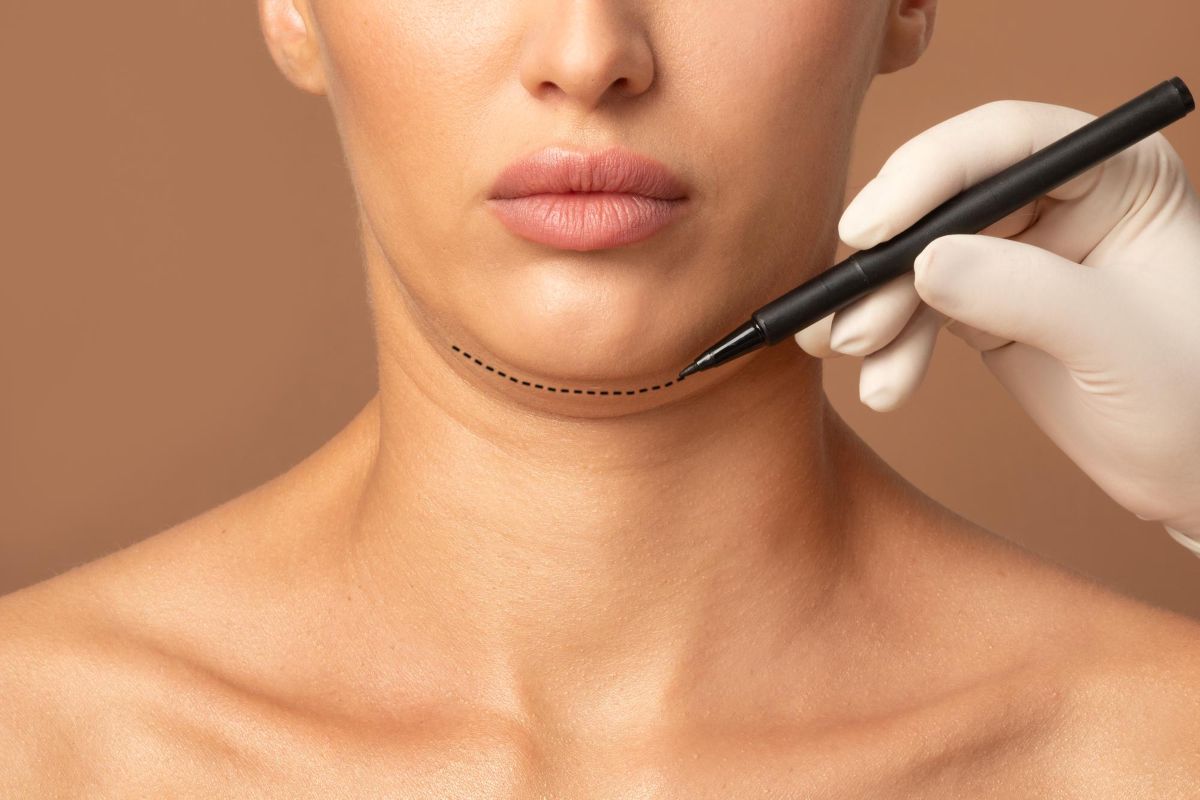 Demarcação no rosto de paciente para cirurgia de cervical lift.