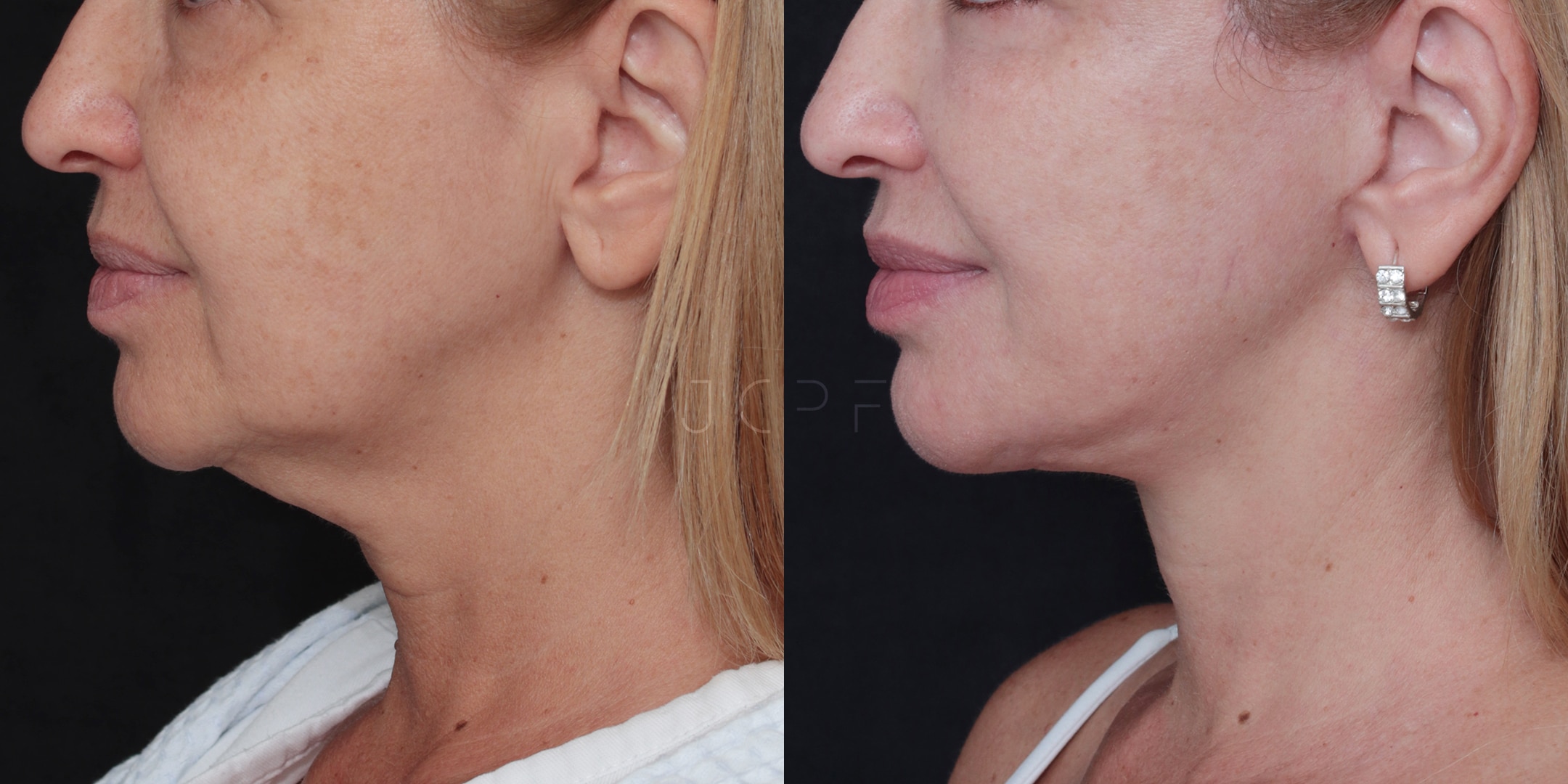 Antes e depois de facelift natural com técnica Deep Plane mostrando melhora da linha da mandíbula e flacidez do pescoço sem aparência artificial.