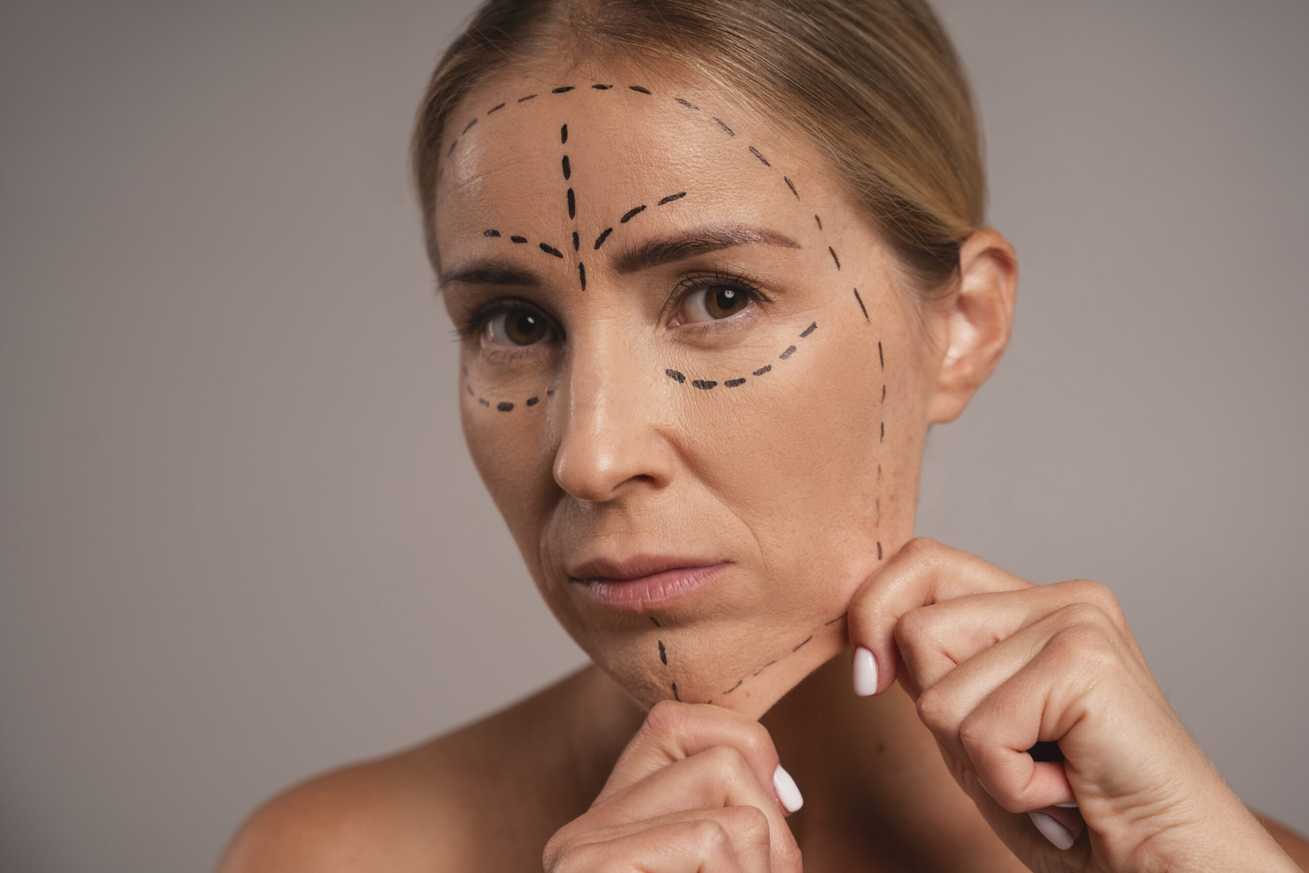Mulher com marcações no rosto para planejamento de cirurgia plástica facial.