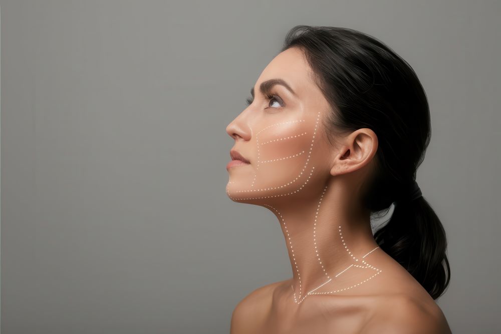 Perfil de mulher com marcações no rosto e pescoço indicando áreas de facelift em São Paulo.